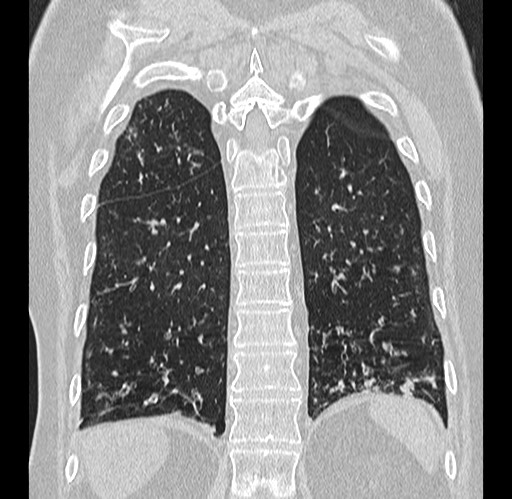 Alpha-1-antitrypsin deficiency (Radiopaedia 72058-82557 Coronal lung window 79).jpg