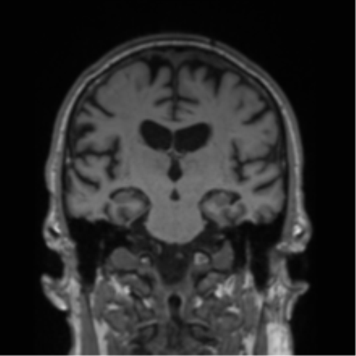 Alzheimer's disease- with Gerstmann syndrome and dressing apraxia (Radiopaedia 54882-61150 Coronal T1 43).png