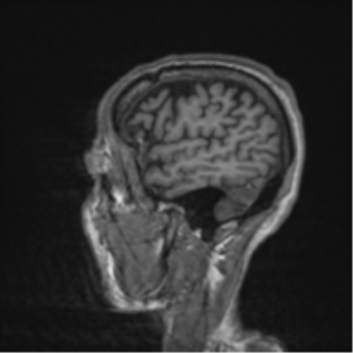 File:Alzheimer's disease- with apraxia (Radiopaedia 54763-61011 Sagittal T1 10).png