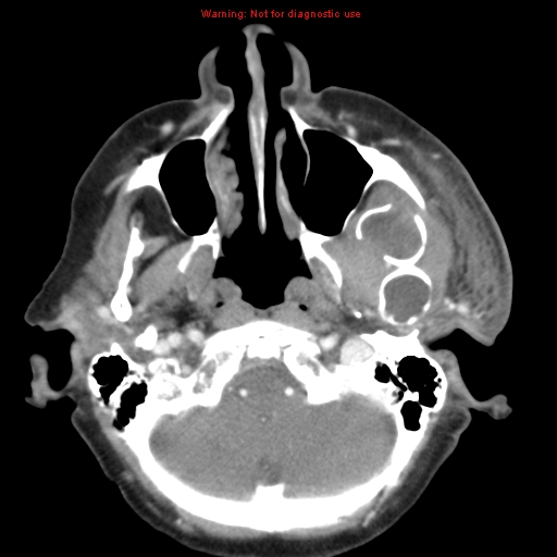 Ameloblastoma (Radiopaedia 27437-27631 A 18).jpg