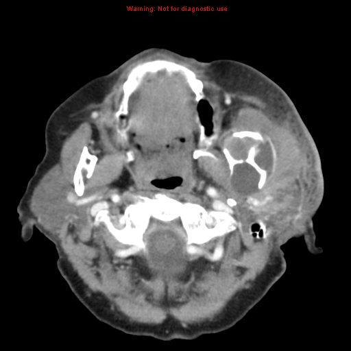 Ameloblastoma (Radiopaedia 27437-27631 A 27).jpg