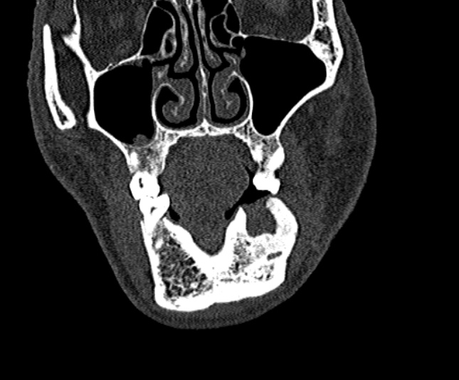 Ameloblastoma (Radiopaedia 51921-57766 Coronal bone window 58).jpg