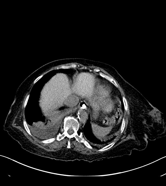 Amiodarone deposition in the liver (Radiopaedia 77587-89780 Axial non-contrast 67).jpg