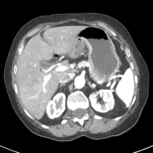 Ampullary adenocarcinoma (Radiopaedia 34013-35237 B 24).png