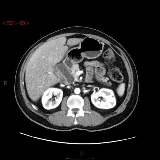 File:Ampullary carcinoma (Radiopaedia 56396-63056 B 29).jpg