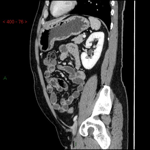 Ampullary carcinoma (Radiopaedia 56396-63056 D 75).jpg