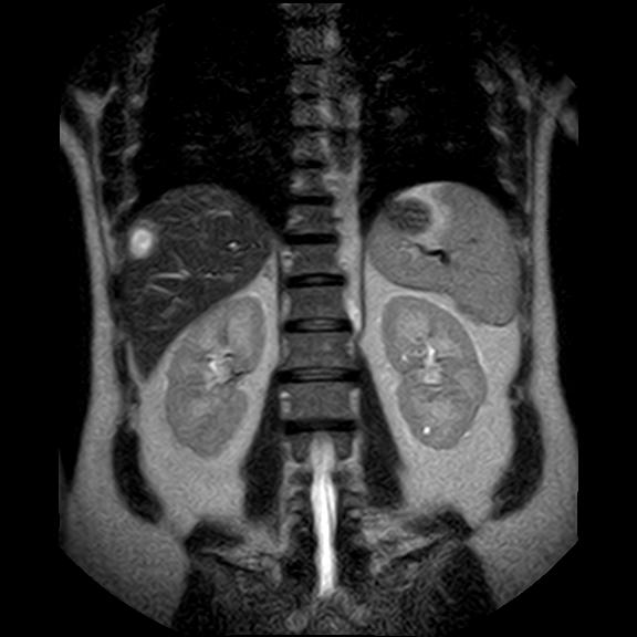 File:Ampullary tumor (Radiopaedia 27294-27479 Coronal T2 19).jpg