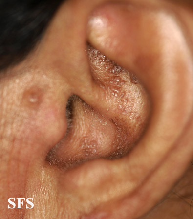 File:Amyloidosis (Dermatology Atlas 5).jpg