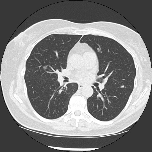 Amyloidosis - bronchial and diffuse nodular pulmonary involvement (Radiopaedia 60156-67744 B 28).jpg