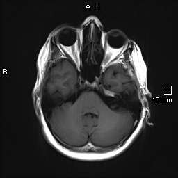 File:Amyotrophic lateral sclerosis (Radiopaedia 70821-81017 Axial T1 8).jpg