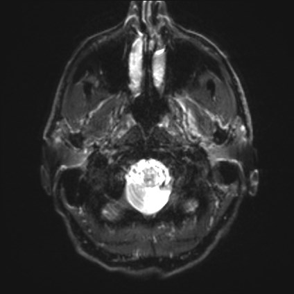 File:Amyotrophic lateral sclerosis (Radiopaedia 87352-103658 Axial DWI 1).jpg