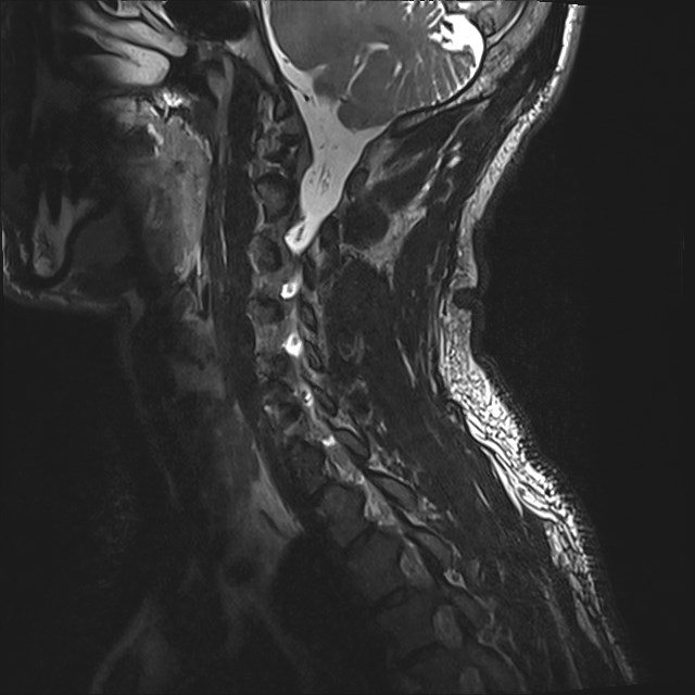 Amyotrophic lateral sclerosis (Radiopaedia 87352-103658 I 16).jpg