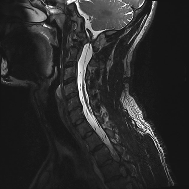 Amyotrophic lateral sclerosis (Radiopaedia 87352-103658 I 41).jpg