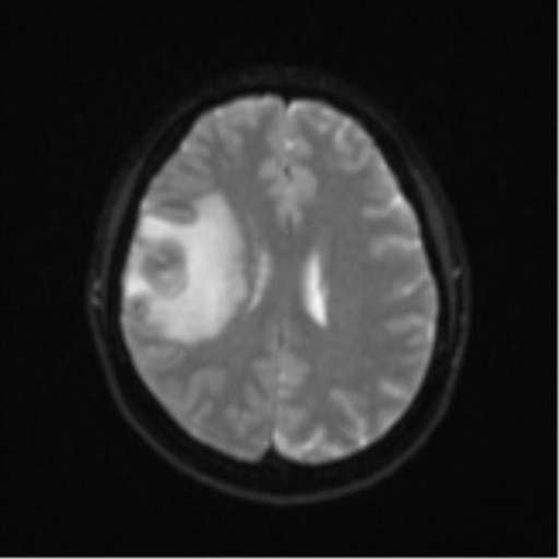 Anaplastic astroblastoma (Radiopaedia 55666-62194 Axial DWI 19).png