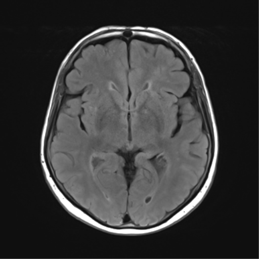 File:Anaplastic astrocytoma (Radiopaedia 86943-103160 Axial FLAIR 14).png