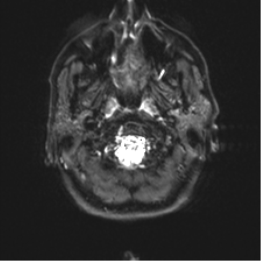 Anaplastic astrocytoma - thalamic glioma (Radiopaedia 59709-67115 Axial DWI 1).png
