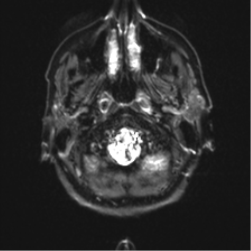 Anaplastic astrocytoma - thalamic glioma (Radiopaedia 59709-67115 Axial DWI 2).png