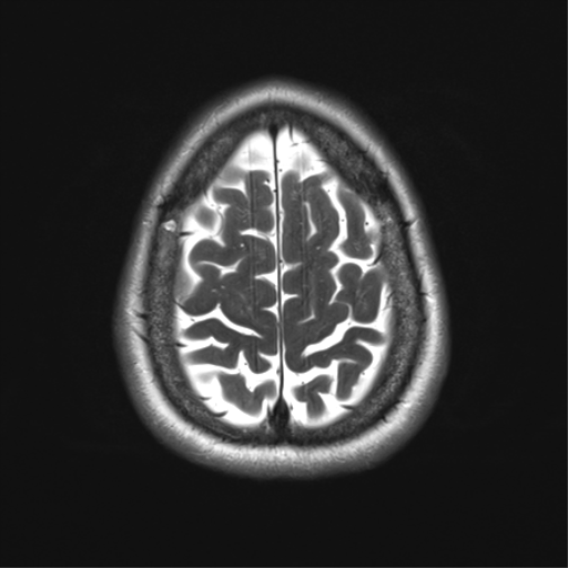 File:Anaplastic astrocytoma - thalamic glioma (Radiopaedia 59709-67115 Axial T2 32).png