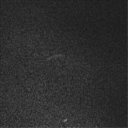 Anaplastic astrocytoma IDH mutant (Radiopaedia 50046-55341 Sagittal T1 C+ 1).png