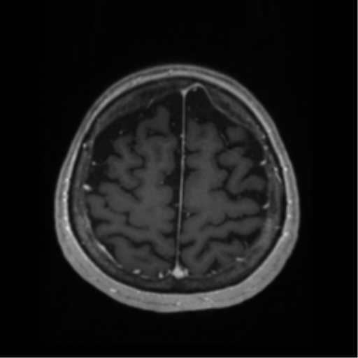 File:Anaplastic astrocytoma IDH wild-type (pseudoprogression) (Radiopaedia 42209-45276 Axial T1 C+ 119).png