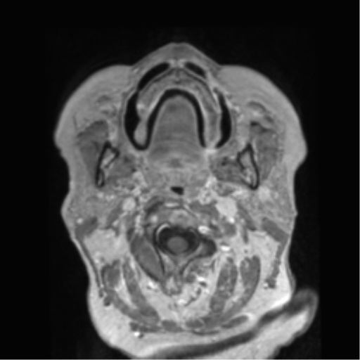 Anaplastic astrocytoma IDH wild-type (pseudoprogression) (Radiopaedia 42209-45278 Axial T1 C+ 2).png