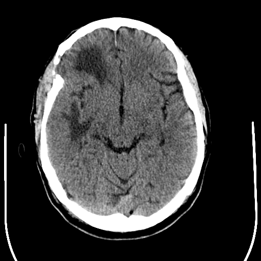 File:Anaplastic meningioma with recurrence (Radiopaedia 34452-35781 Axial non-contrast 14).png