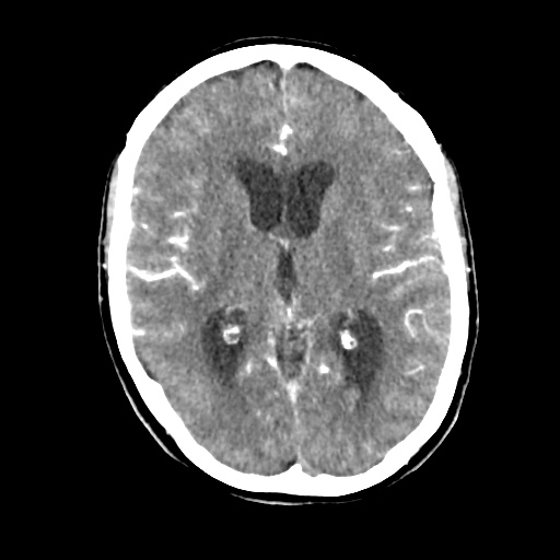 Aneursym related subarachnoid hemorrhage with hydrocephalus (Radiopaedia 45105-49084 D 28).jpg