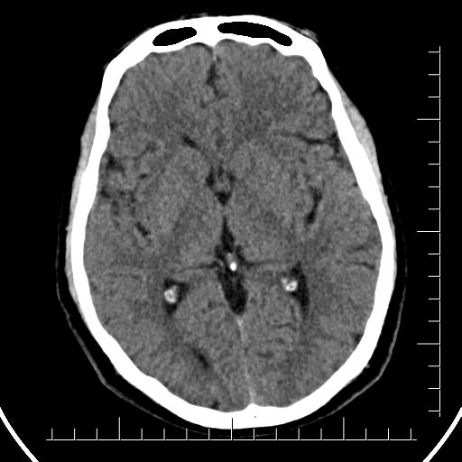 File:Aneurysm of posterior communicating artery (Radiopaedia 20188-20162 Axial non-contrast 24).jpg