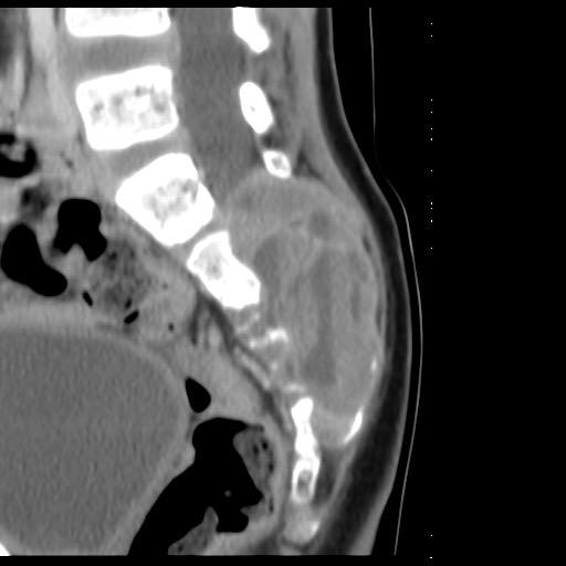 File:Aneurysmal bone cyst - sacrum (Radiopaedia 65190-74195 A 17).jpg