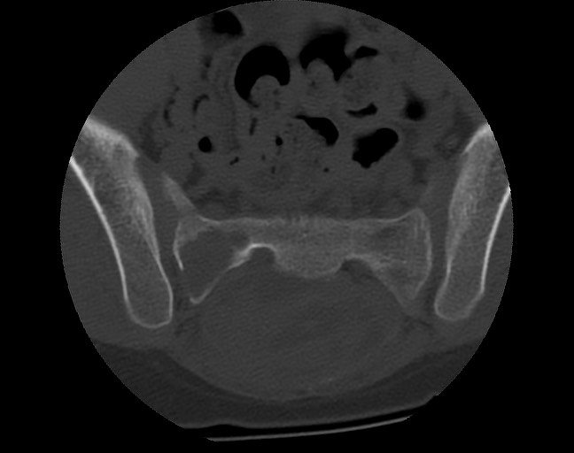 Aneurysmal bone cyst - sacrum (Radiopaedia 65190-74195 Axial bone window 26).jpg