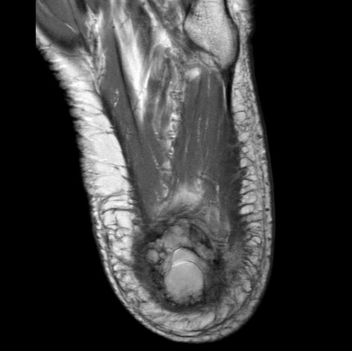 File:Aneurysmal bone cyst of the calcaneus (Radiopaedia 60669-68420 Axial PD 3).jpg