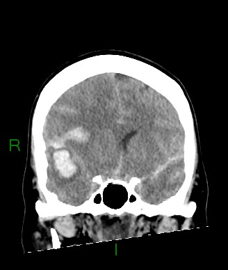Aneurysmal subarachnoid hemorrhage with intra-axial extension (Radiopaedia 84371-99699 Coronal non-contrast 43).jpg