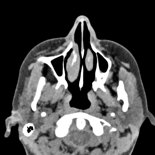 Angular dermoid cyst (Radiopaedia 88967-105790 Axial non-contrast 9).jpg
