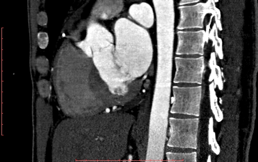 File:Anomalous left coronary artery from the pulmonary artery (ALCAPA) (Radiopaedia 70148-80181 C 123).jpg