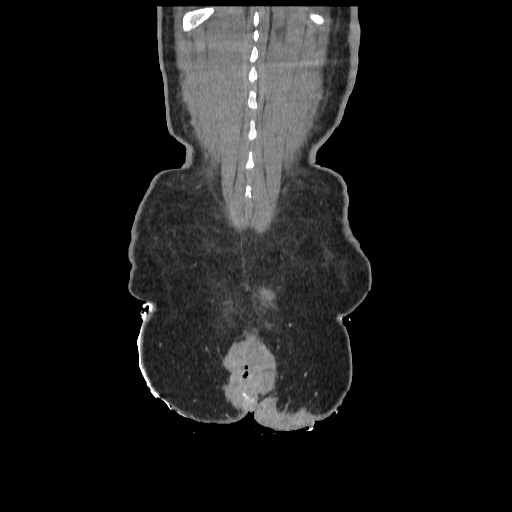 Anorectal carcinoma (Radiopaedia 44413-48064 B 89).jpg