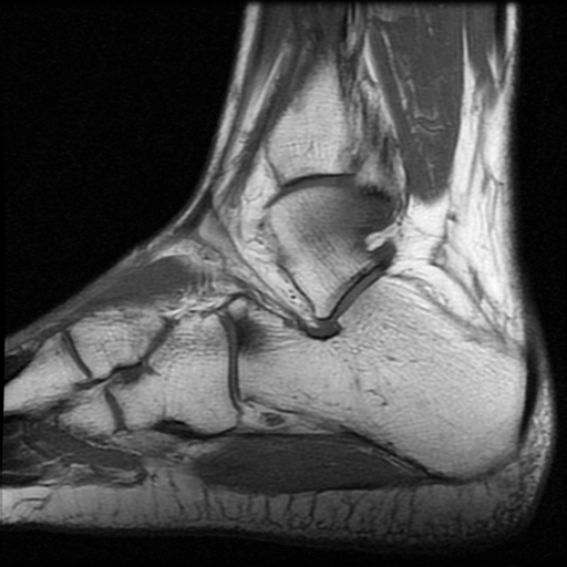 File:Anterior calcaneal process fracture (Radiopaedia 74654-85611 Sagittal T1 15).jpg