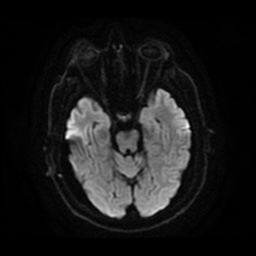 Anterior cerebral artery infarction (Radiopaedia 46794-51323 Axial DWI 11).jpg