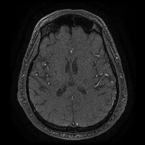 Anterior cerebral artery infarction (Radiopaedia 46794-51323 Axial MRA 125).jpg