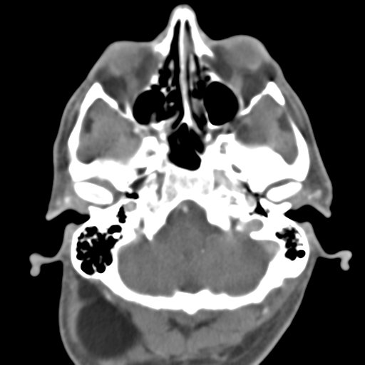File:Anterior cerebral artery territory infarct (Radiopaedia 39327-41581 B 47).png