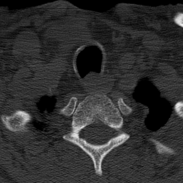 Anterior cervical postdiscectomy arthrodesis (Radiopaedia 32678-33646 Axial bone window 68).jpg