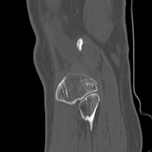 File:Anterior cruciate ligament avulsion fracture (Radiopaedia 58939-66194 Sagittal bone window 4).jpg
