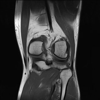 File:Anterior cruciate ligament full thickness tear (Radiopaedia 66268-75467 Coronal T1 15).jpg