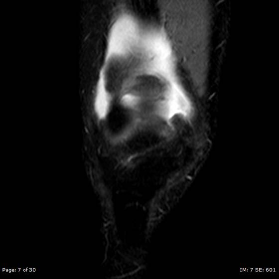 File:Anterior cruciate ligament tear (Radiopaedia 70783-80964 Coronal STIR 7).jpg