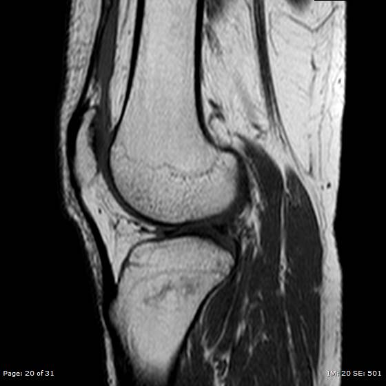 File:Anterior cruciate ligament tear (Radiopaedia 70783-80964 Sagittal T1 20).jpg