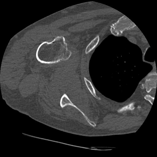 Anterior glenohumeral dislocation with Hill-Sachs lesion (Radiopaedia 62877-71249 Axial bone window 54).jpg