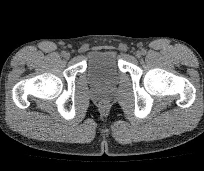 Anterior inferior iliac spine avulsion fracture (Radiopaedia 81312-94999 Axial non-contrast 60).jpg
