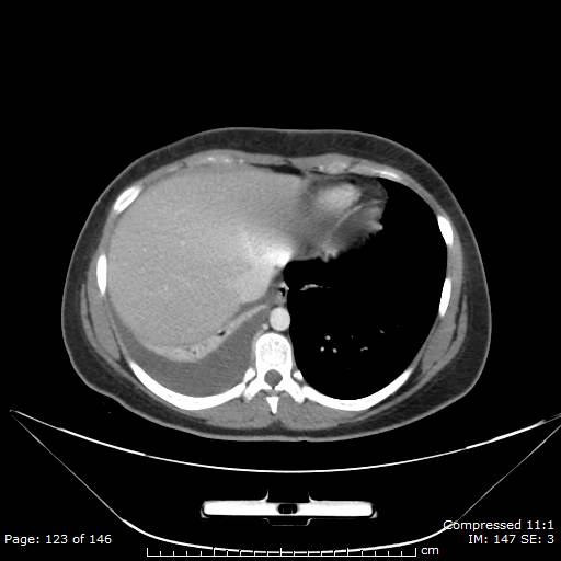 Anterior mediastinal B cell Lymphoma (Radiopaedia 50677-56114 A 62).jpg