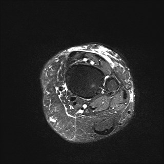 File:Anterior talofibular ligament injury - rupture with soft-tissue impingement (Radiopaedia 38765-40928 Axial T2 fat sat 5).jpg