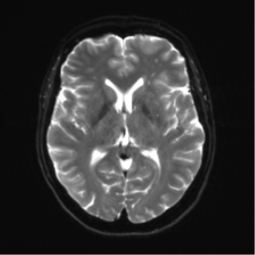Anterior temporal lobe perivascular space (Radiopaedia 40946-43650 Axial DWI 14).png
