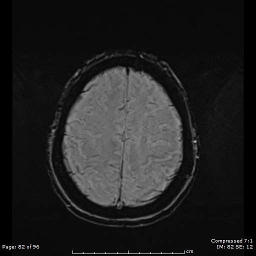 File:Anterior temporal lobe perivascular space (Radiopaedia 88283-104914 Axial SWI 51).jpg
